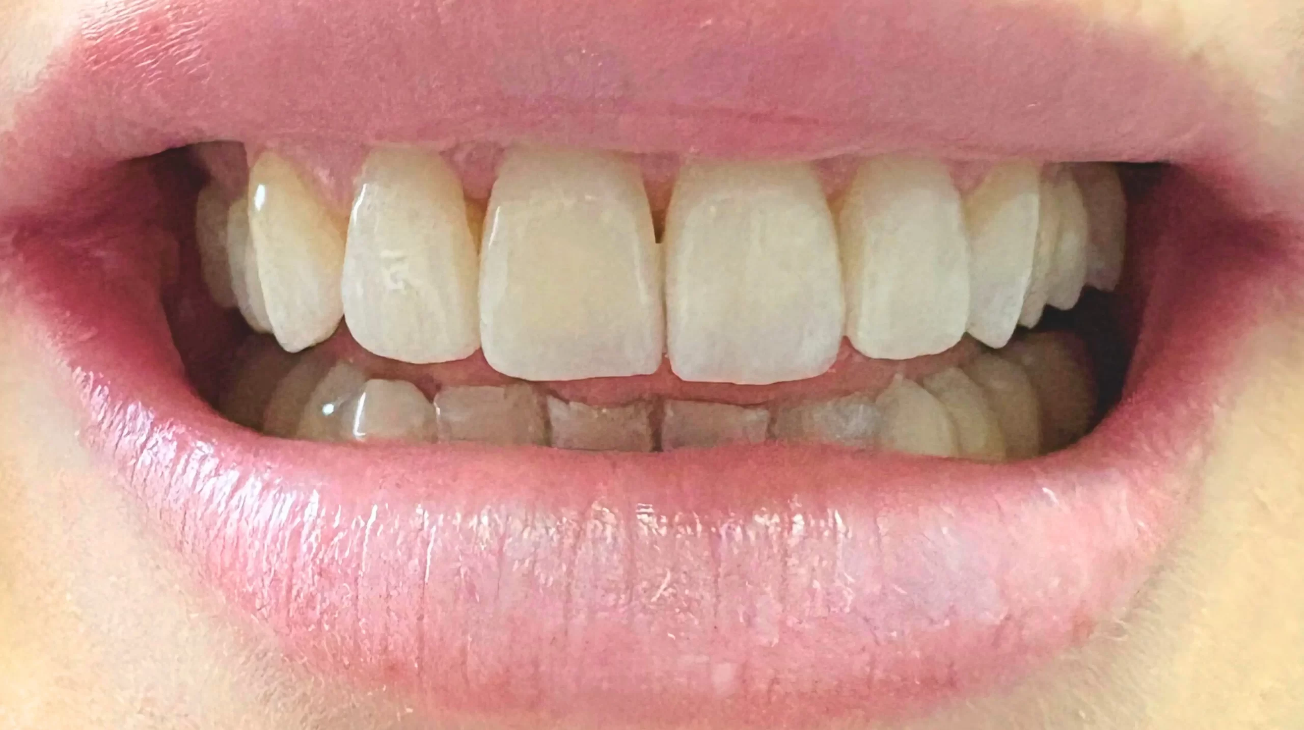 Faccette-dentali1_dopo