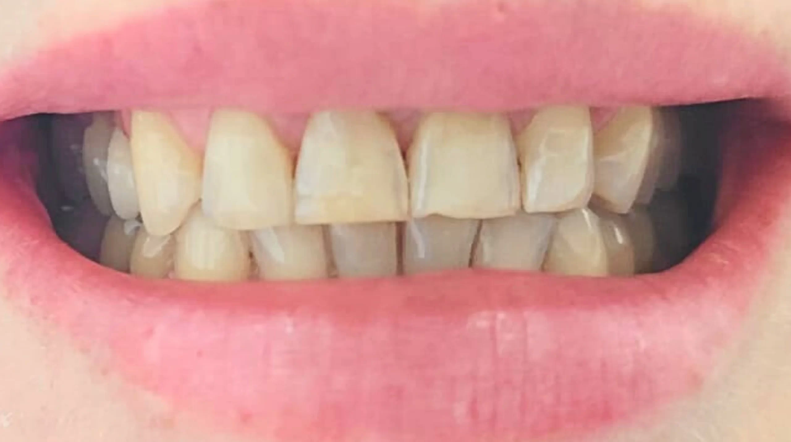 Faccette-dentali1_prima