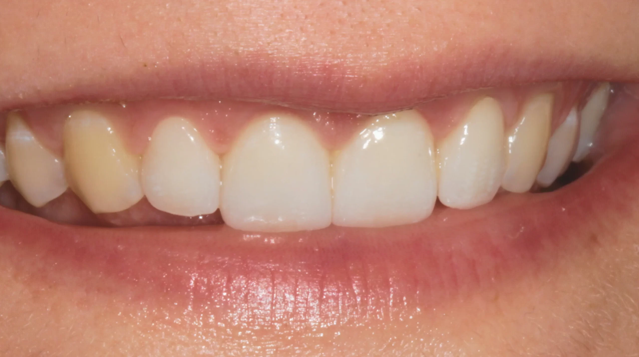 Faccette-dentali2_dopo