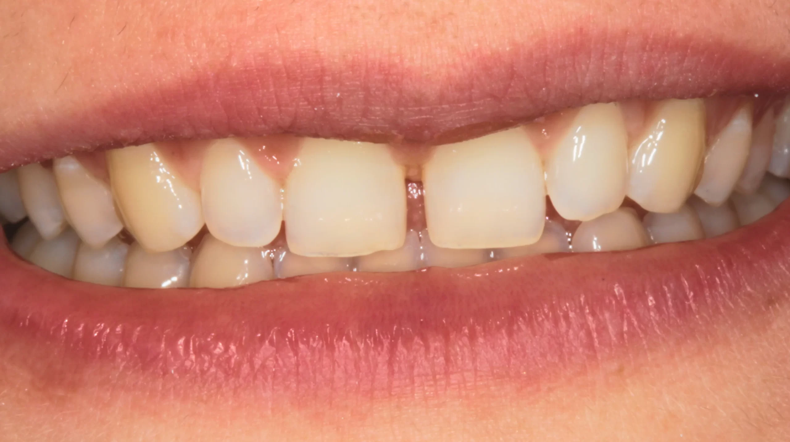 Faccette-dentali2_prima